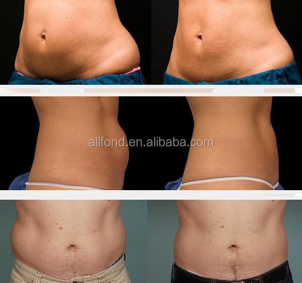 High quality pure saffron extract slimming machine AF-S26 (CRYO+CAVI+RF+LASER 4 in 1)