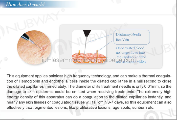 CE Approval 30MHZ High Frequency Non-invasive Vein Stopper Portable Spider Vein Removal Machine on sale.png