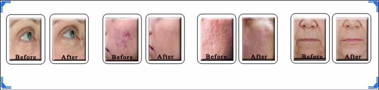 Er Yag Laser 2940nm Fractional.jpg
