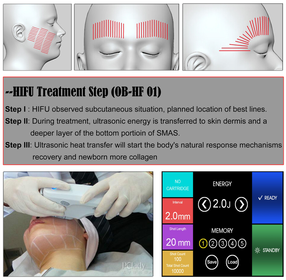 集束超音波hifu最新しわの除去皮膚締めサロン機器( ostarbeauty) hf01問屋・仕入れ・卸・卸売り