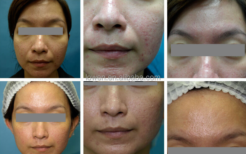 alibabaの販売のmicrodermabrasionの美容機器問屋・仕入れ・卸・卸売り