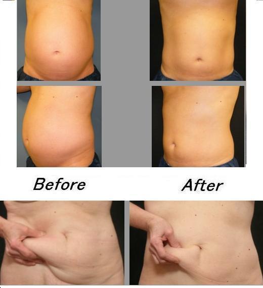 Abdomen fat loss.JPG