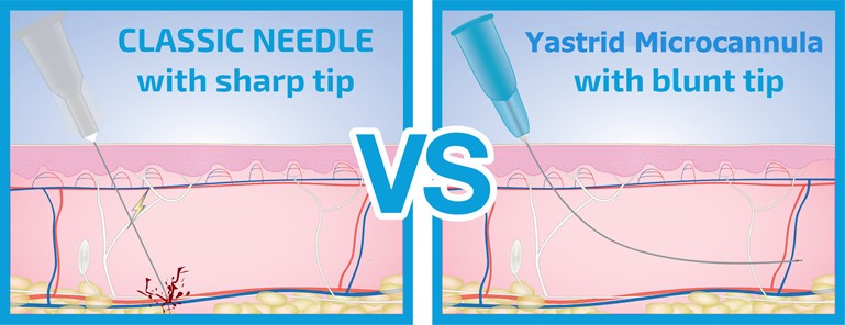 Benefits of Microcannulas Compared to Needles from Yastrid