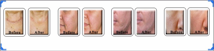 Er Yag Laser 2940nm Fractional.jpg