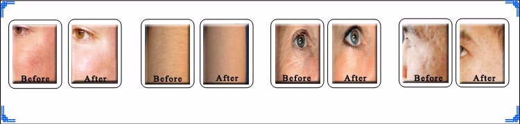 wrinkle pigmentation removal face lift.jpg