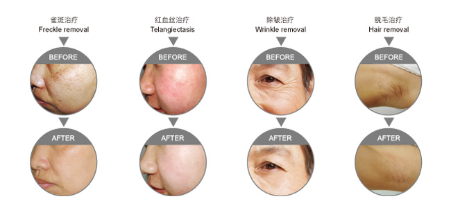 新しい個人2014年エステサロン用品||上の製品のために、 中国市場皮膚のすべての種類問屋・仕入れ・卸・卸売り