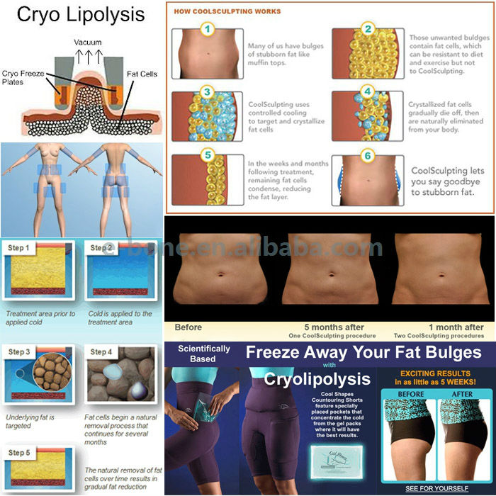 プロのホットなcryolipolysis脂肪の凍結cryolipolysis痩身マシン垂直問屋・仕入れ・卸・卸売り
